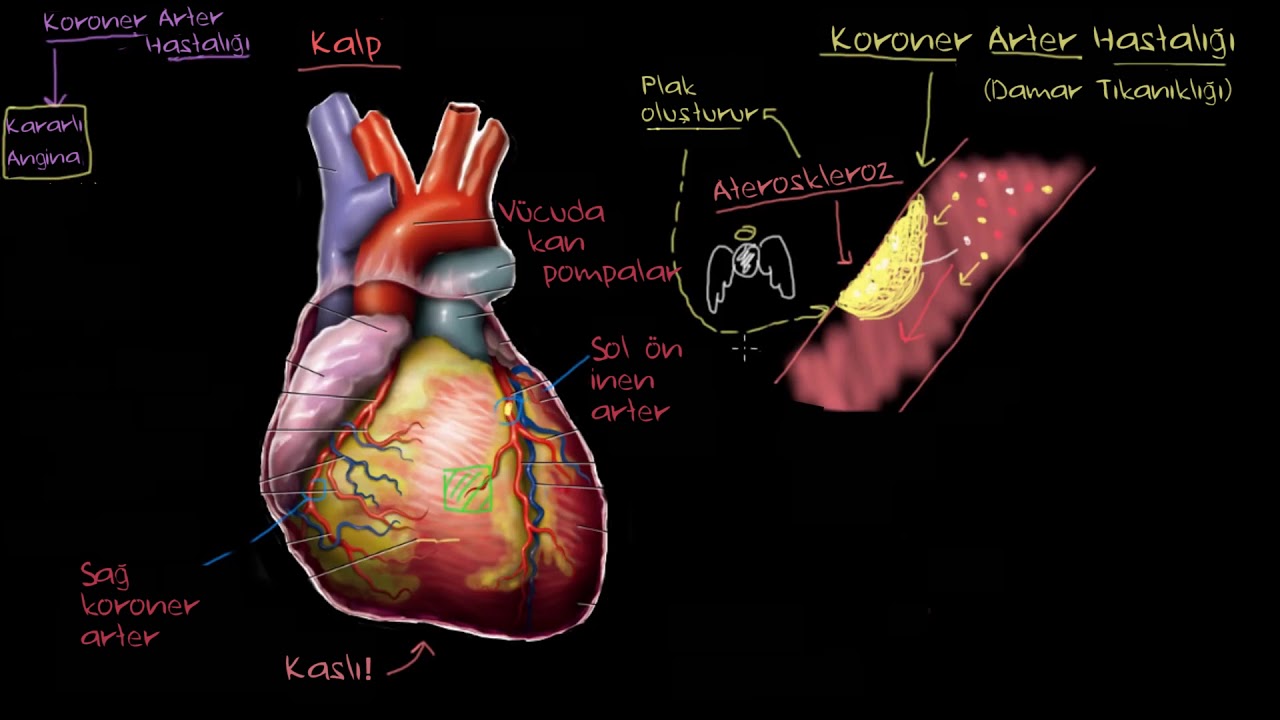Koroner Arter Hastalığı Nedir? (Fen Bilimleri) (Sağlık ve Tıp)