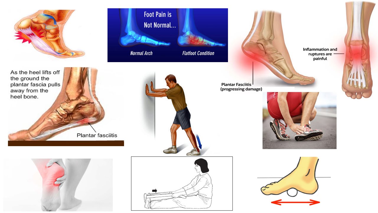 Correct Plantar Fasciitis Quickly! (Medically Proven) The Best Exercises & Stretches - Dr Mandell