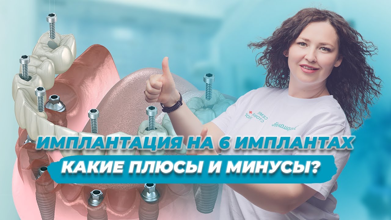 Плюсы и минусы имплантации зубов ALL ON 6 или ВСЕ НА 6. Стоматология Вариант в Самаре