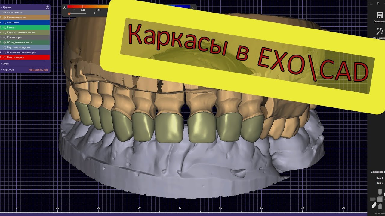 Моделировка циркониевого каркаса в EXOCAD полностью Моделирование зубов на компьютере. Керамика