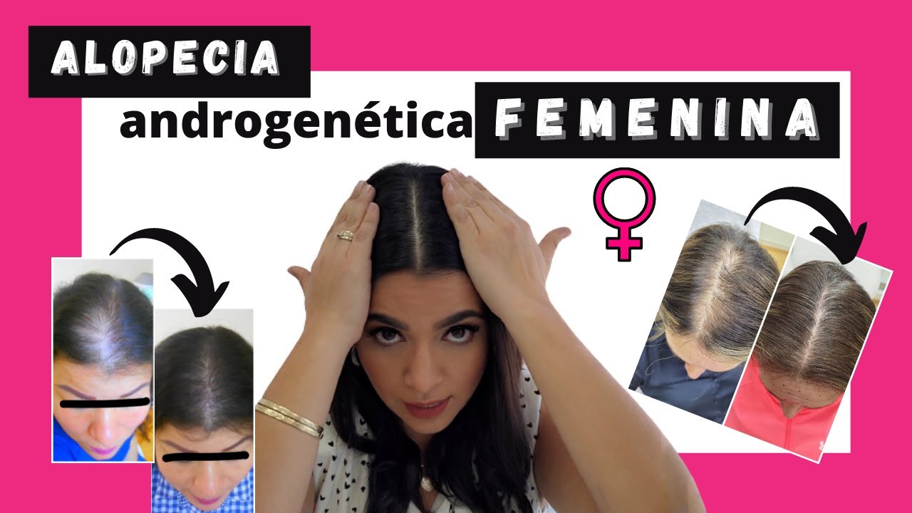 👩🏽Calvicie Femenina👩🏻‍🦰/ Alopecia Androgenética Femenina🚺