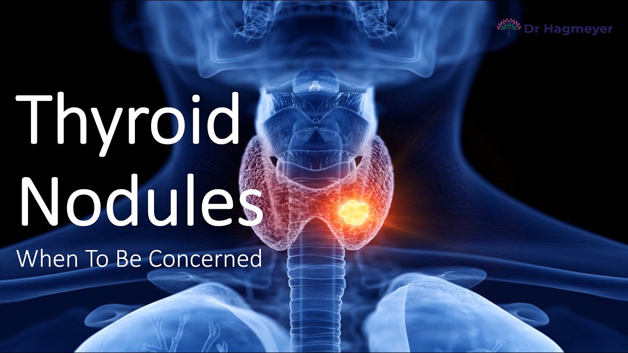 When You Need To Be Concerned About Thyroid Nodules