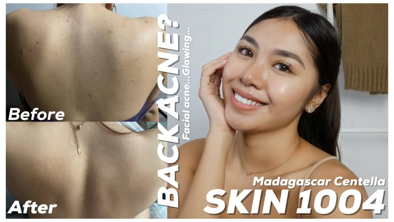 SKIN1004 MADAGASCAR CENTELLA HONEST REVIEW FOR 5 DAYS! BACK & FACIAL ACNE GONE? by Lhianne Lauren
