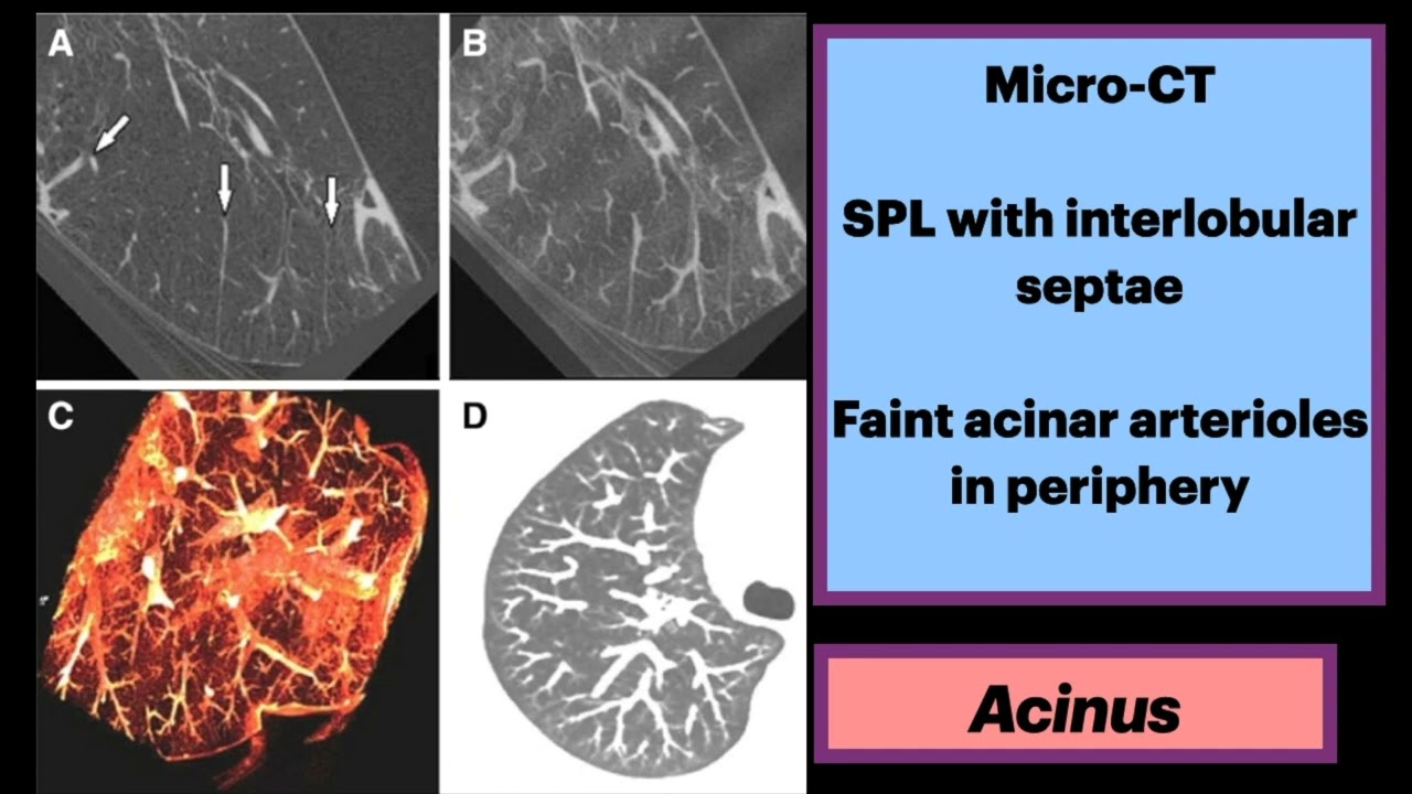 Acinus #Radiology #Anatomy #Pulmonology