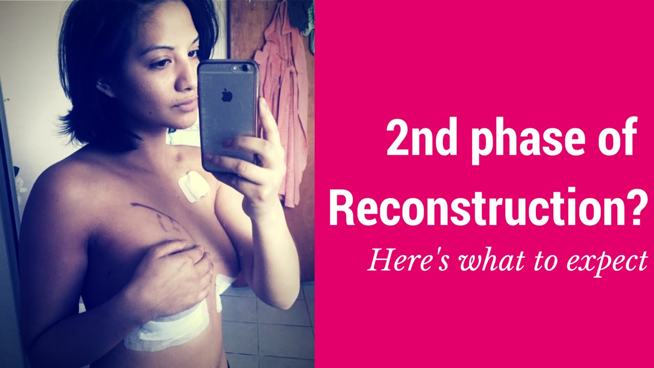 What to expect for your 2nd Phase of Reconstruction [Breast Cancer]