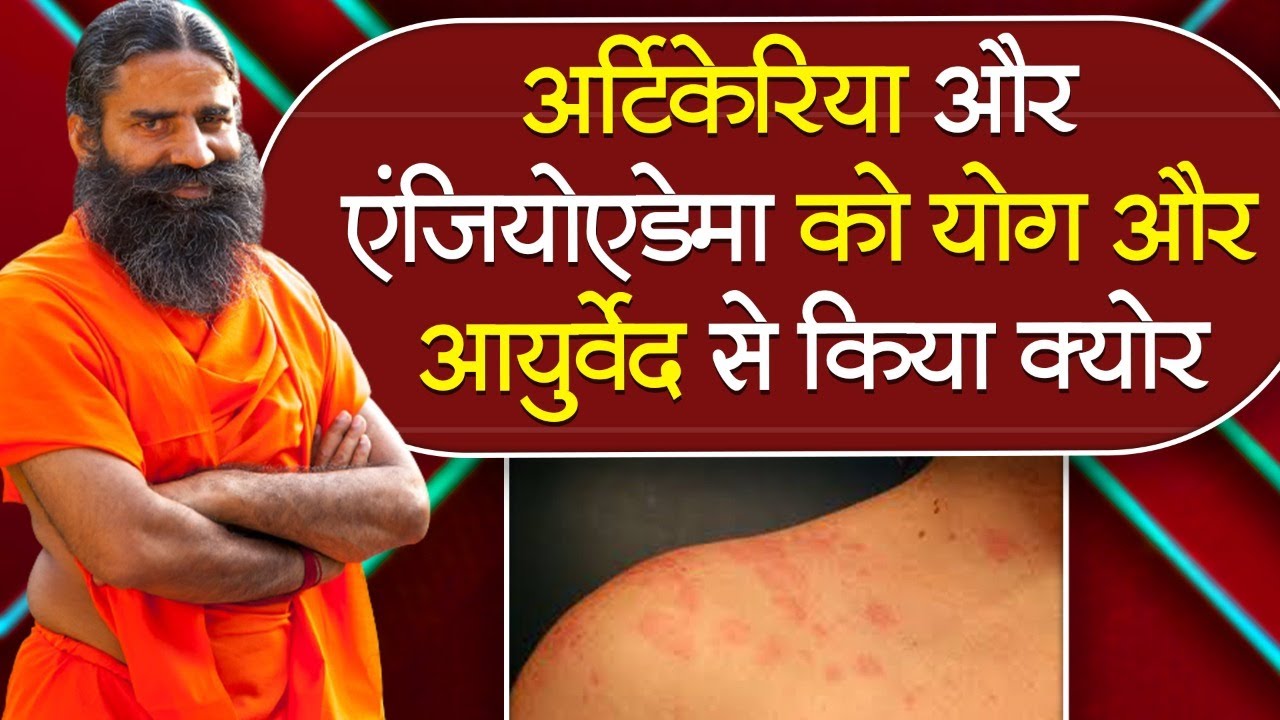 अर्टिकेरिया और एंजियोएडेमा को योग और आयुर्वेद से किया क्योर || Swami Ramdev