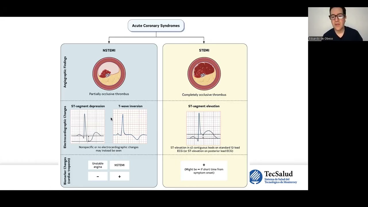 Sesión de experto: síndrome coronario agudo