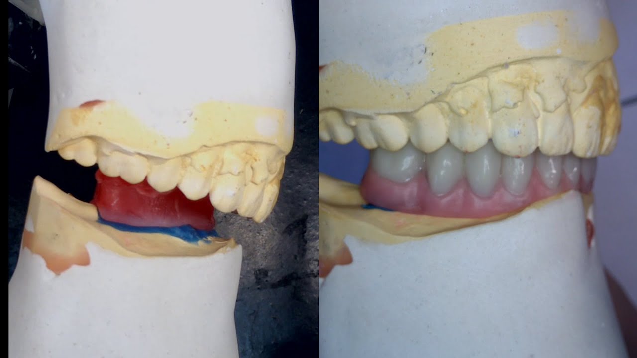 Montagem de Dentes para Protocolo Inferior - Caso Difícil!! Classe II Angle