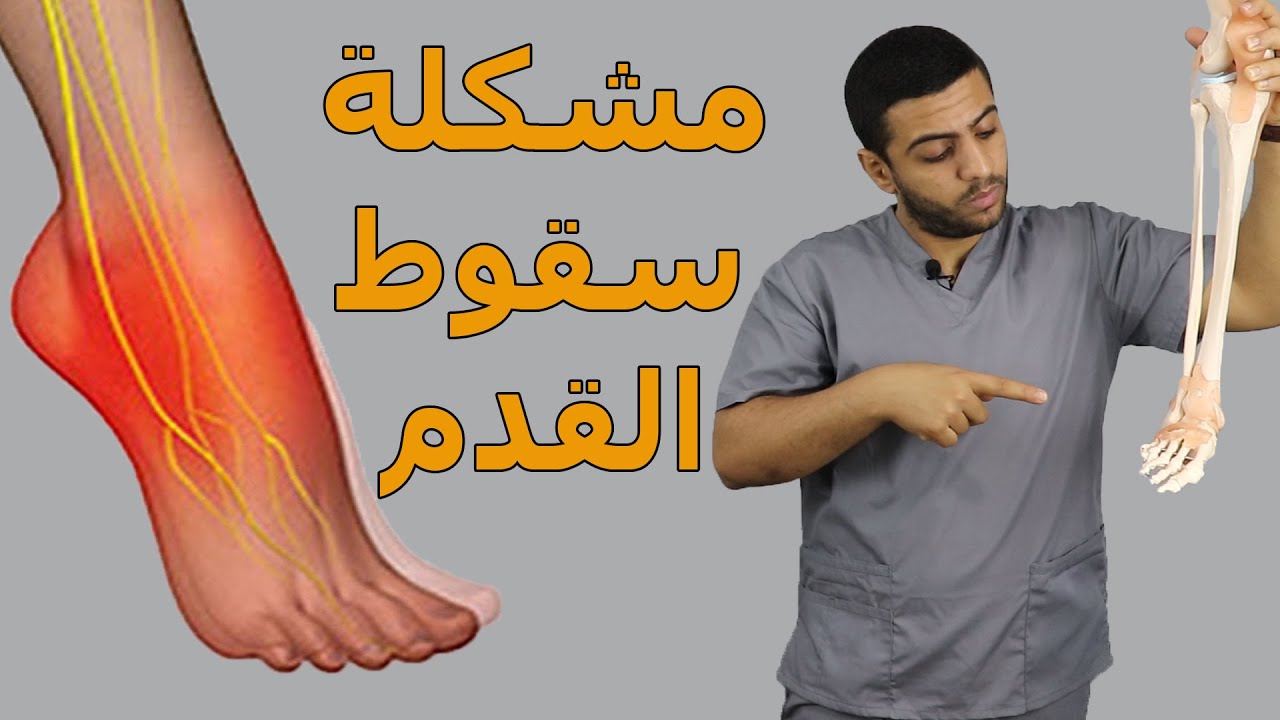 سقوط القدم/اسباب وعلاج مشكلة سقوط القدم