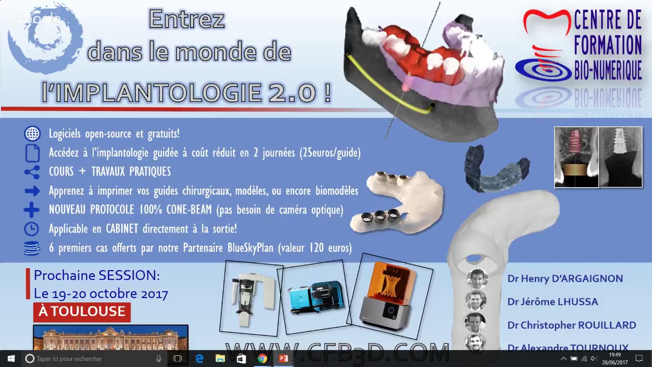 PRISE EN MAIN DE BLUESKY PLAN: DU CONE BEAM À LA CONCEPTION D'UN GUIDE CHIRURGICAL