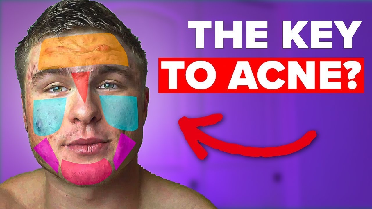 What Does Your Acne Mean By Location? (Face Maps)
