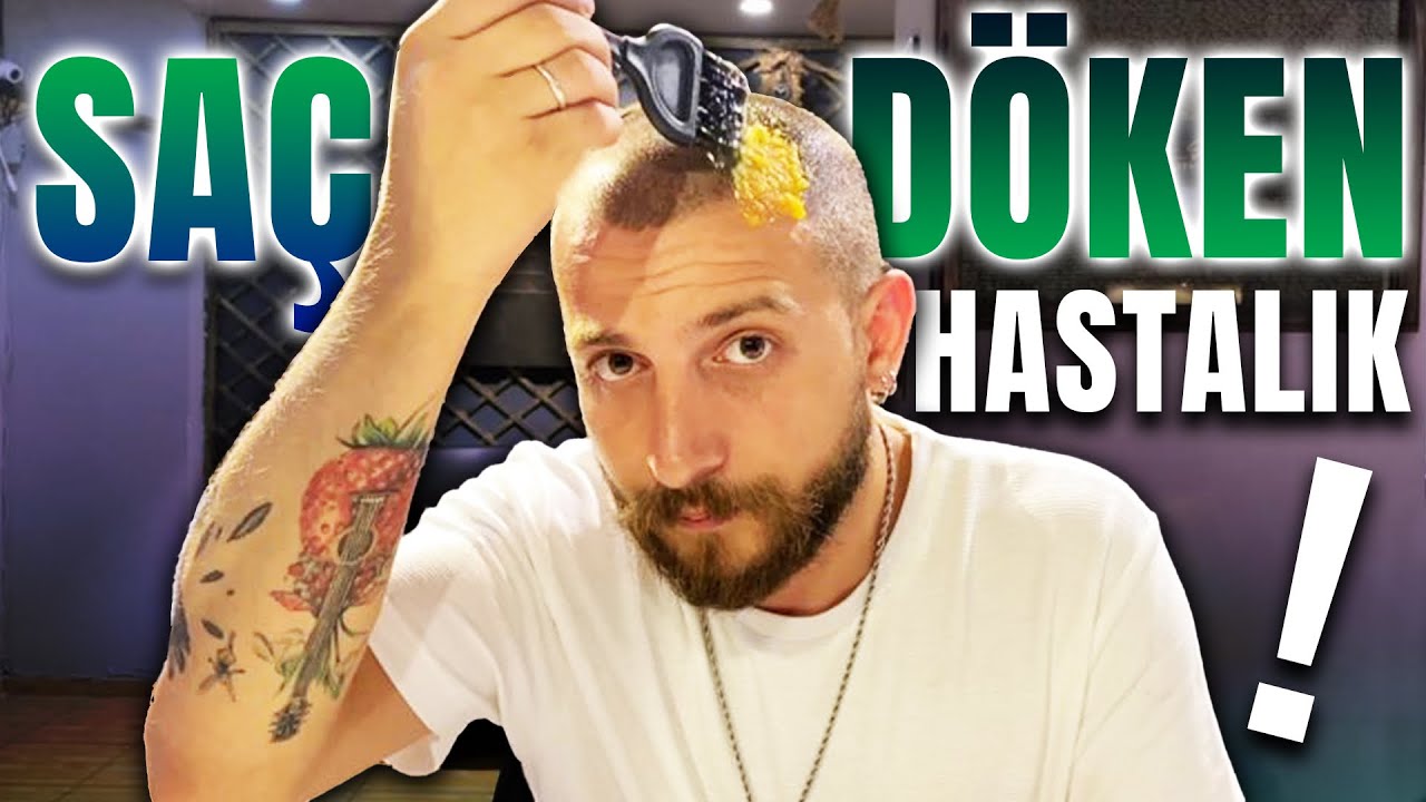 KAFAMDA SAÇKIRAN ÇIKTI! SAÇLARIM DÖKÜLDÜ! (Alopesi Areata Tedavisi)