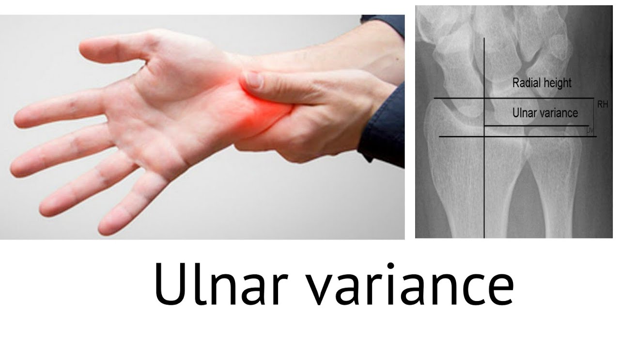Ulnar variance, negative and positive ulnar variance #complications#treatment