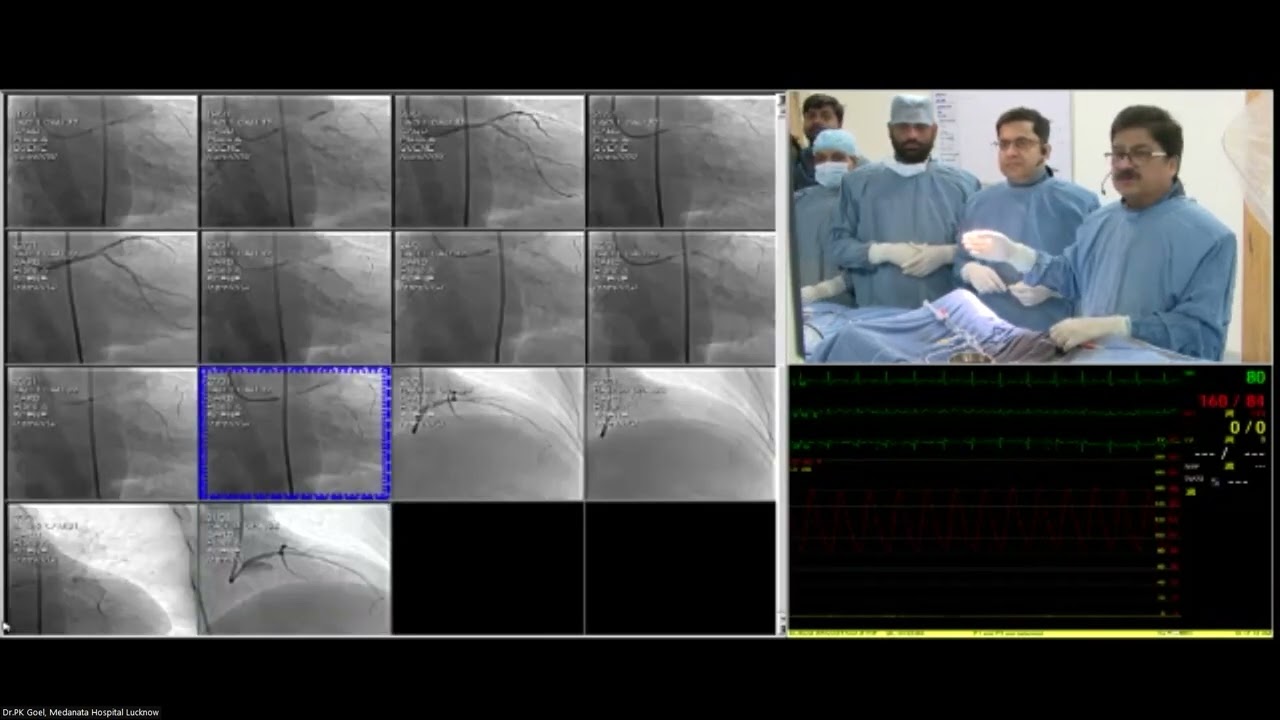 TCT India South Asia 2023   27th 29th July 2023   JWCC Mumbai   Day 2   Live Case by Dr  PK Goel, Lu