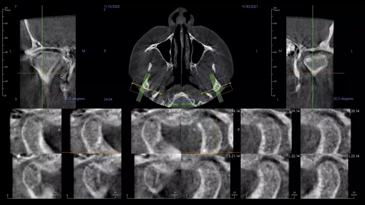 TMD Analysis - AM - TMJ