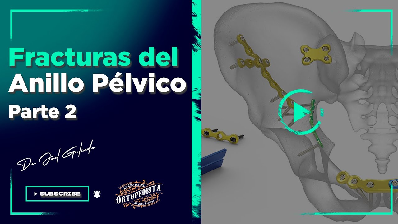 Fracturas del anillo pélvico | Segunda Parte
