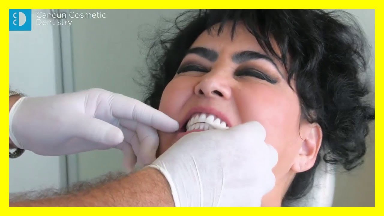 ✔️ SNAP in DENTURES can be finished in ONE WEEK in 2021!  🏃‍♀️🎌🦷 See how she got an amazing smile