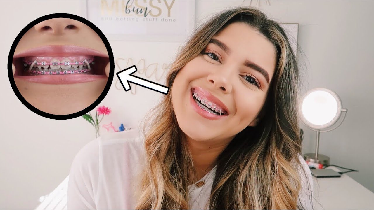 braces update | power chains, elastics and turbos!