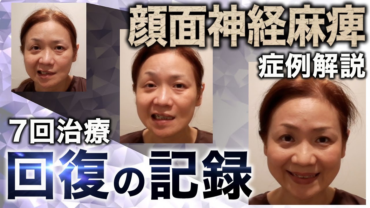 【顔面神経麻痺】ラムゼイ・ハント症候群の方の治療｜初回・3回・7回目の比較