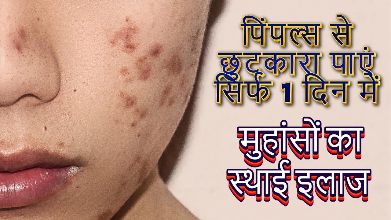 Remove Pimples Forever In 1 Day | असरदार घरेलू नुस्खे | | Home Remedy For Pimples | Health Tips