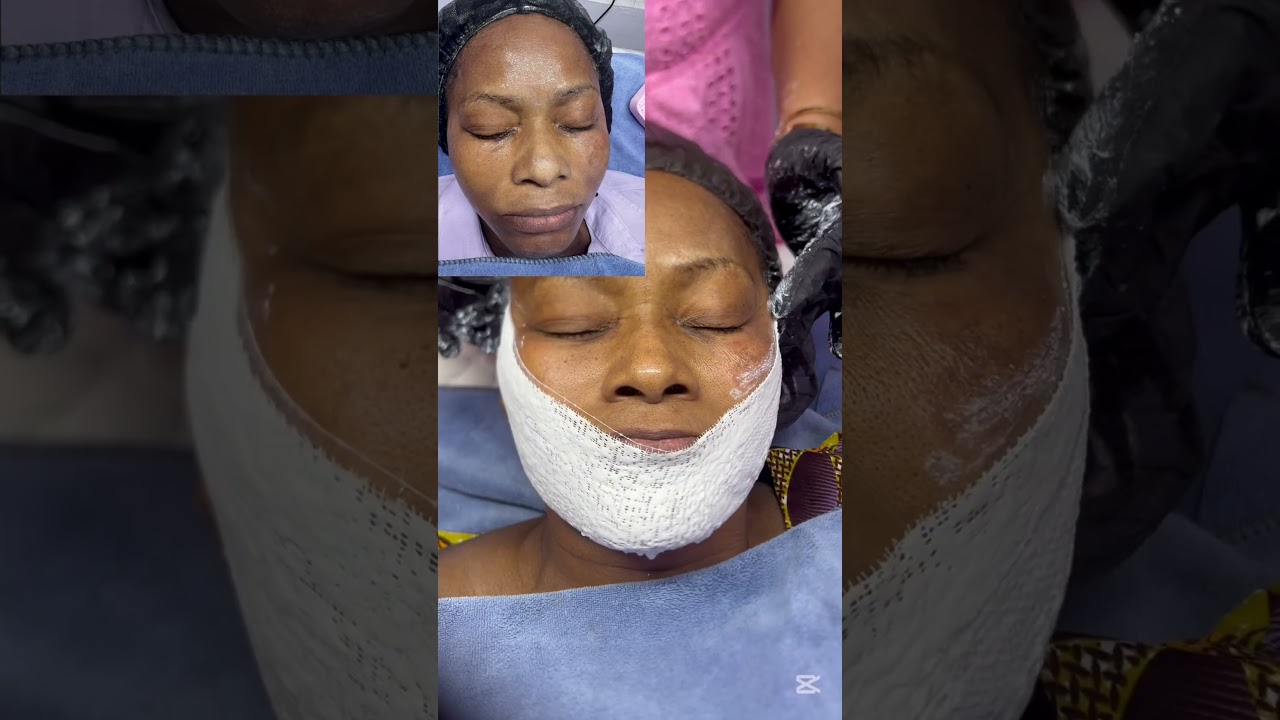 Exogenous ochronosis treatment