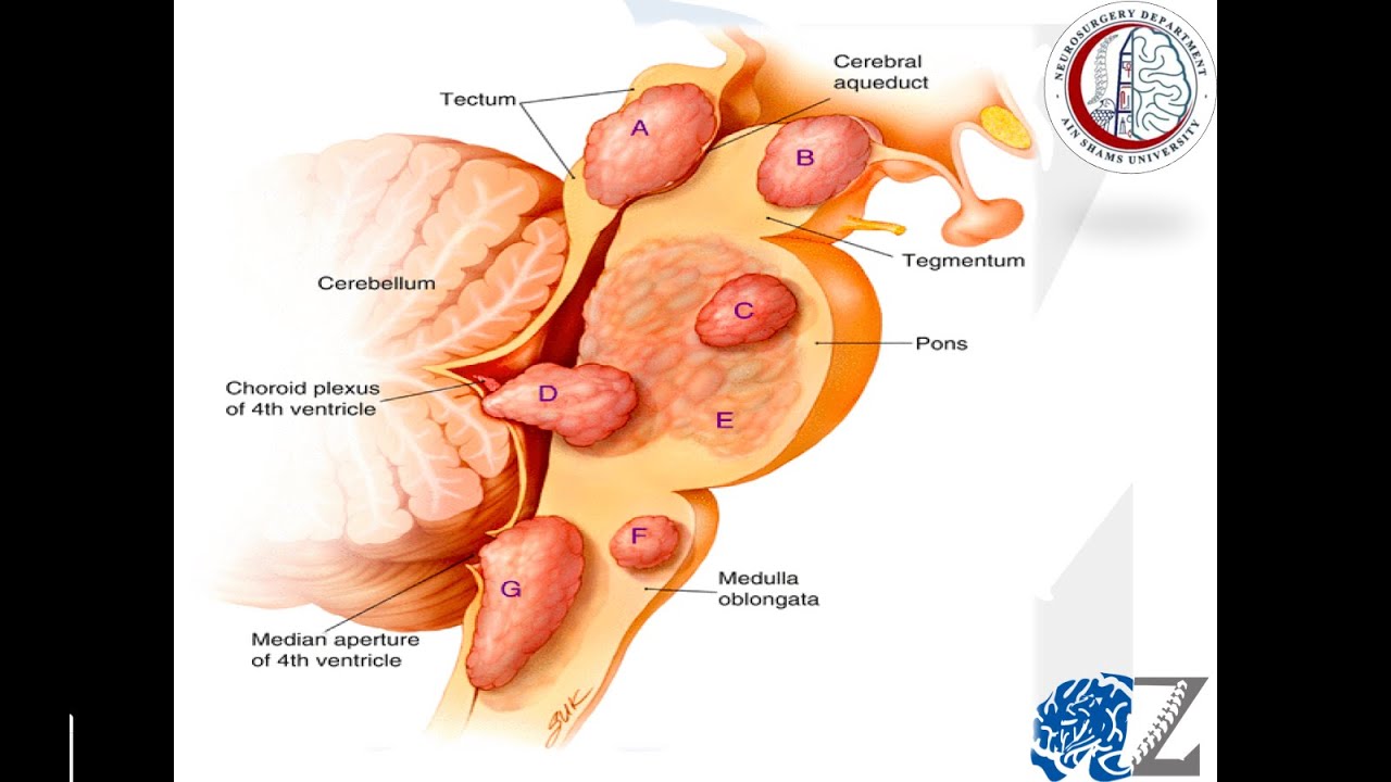 Brain Tumours (13):  Gliomas (11) : Brainstem Gliomas     أورام جذع المخ الدبقية/النجمية