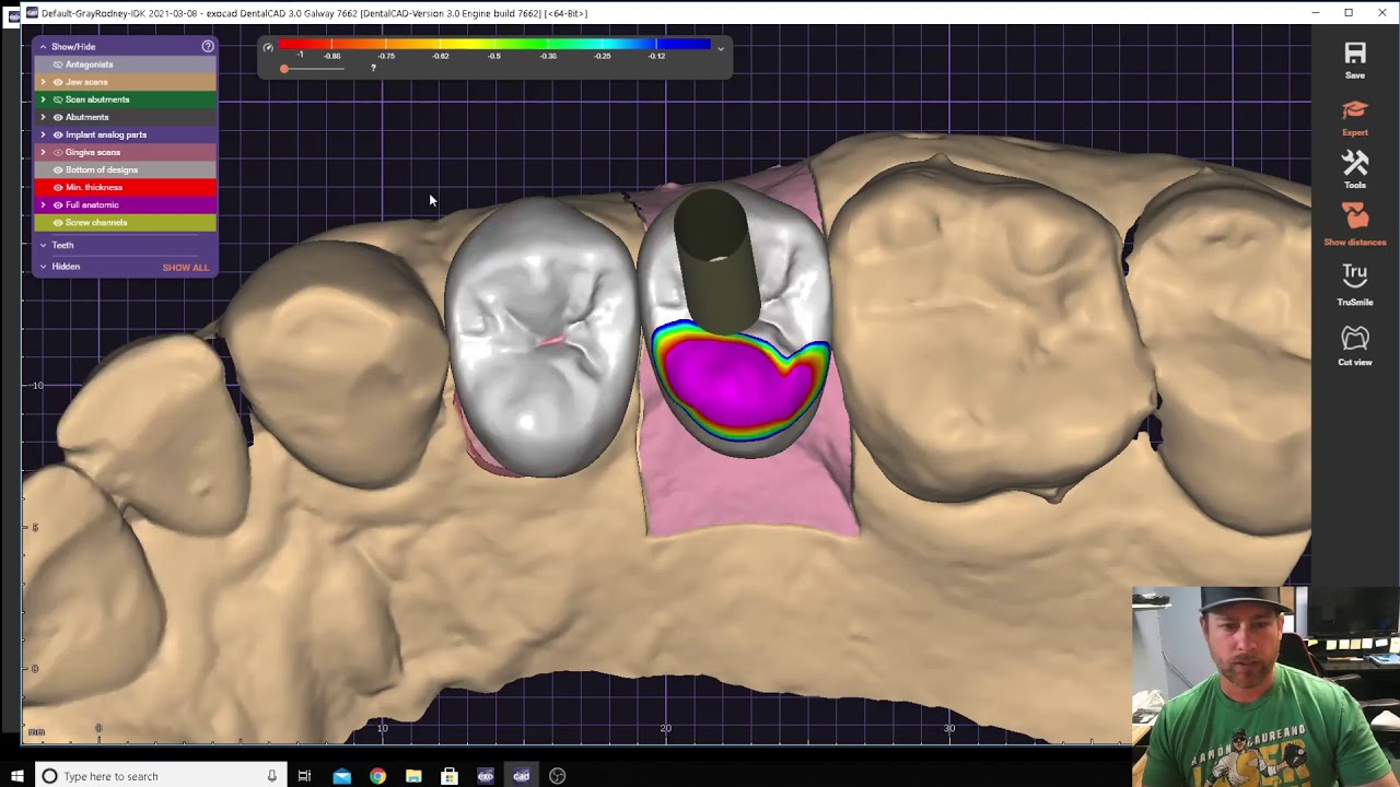 Exocad: Screw-Retained and Single Bicupid Design. (No Audio, my bad)