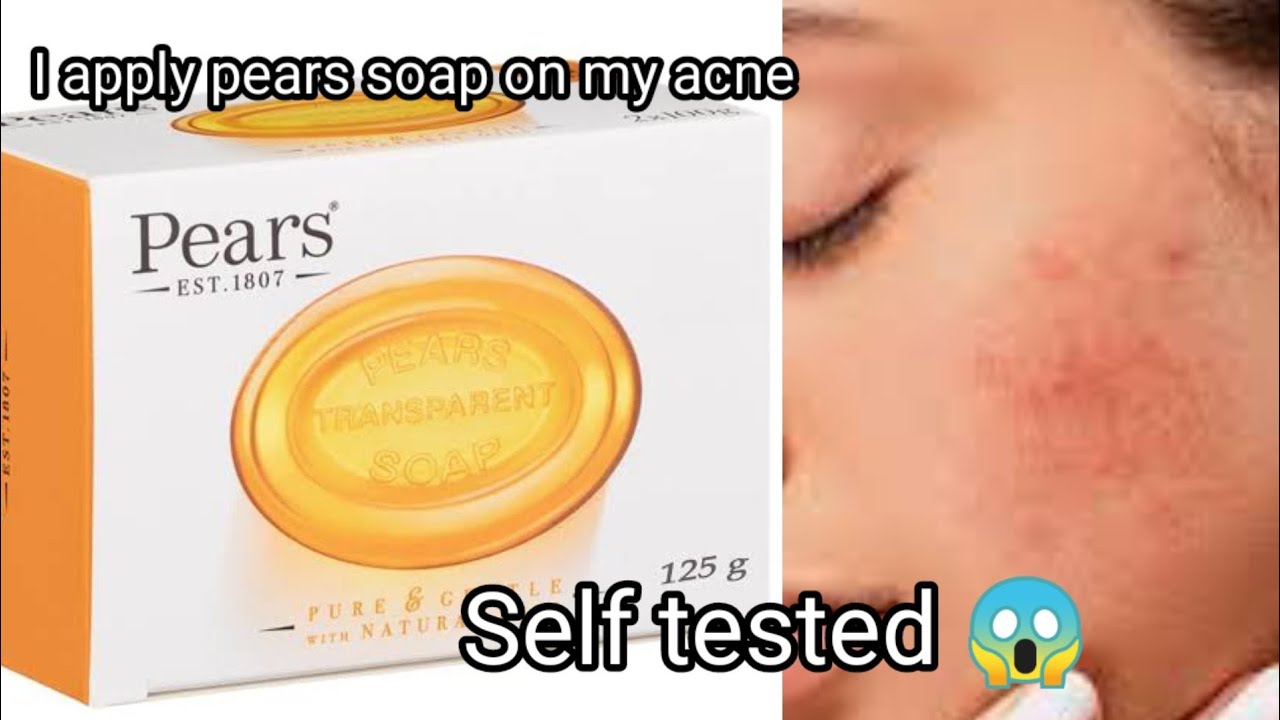 I use pears soap on my acne|pears soap review|pears soap rock my acne are shock|face & body soap