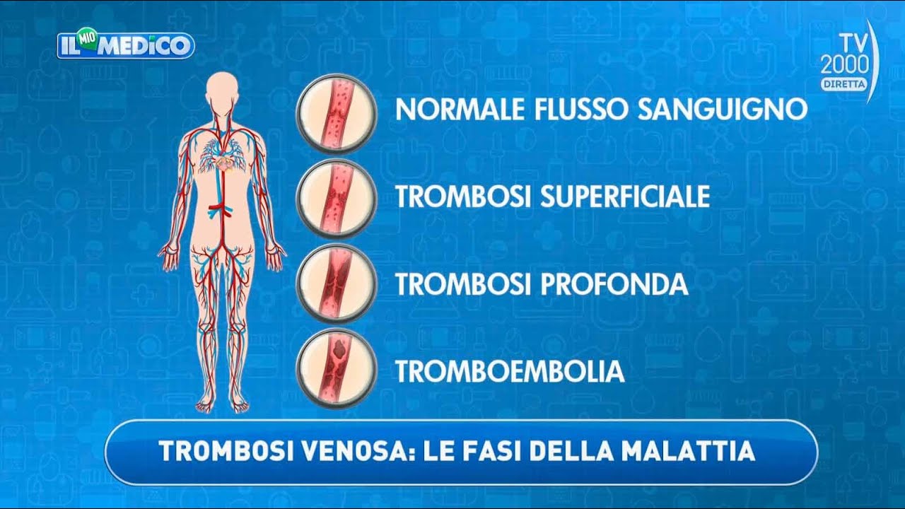 Il Mio Medico (Tv2000) - Come riconoscere e curare una trombosi