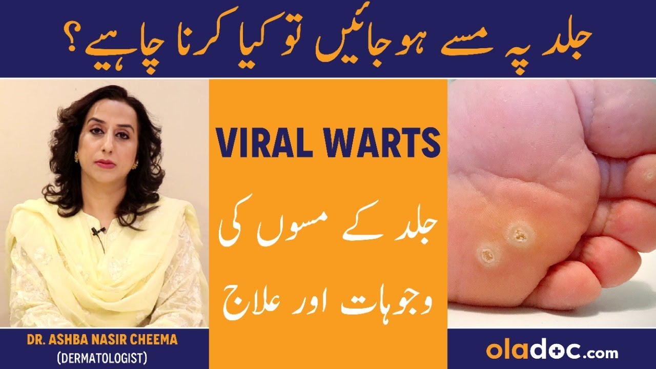 Viral Warts Causes & Treatment - Skin Ke Masse Ka Ilaj - Warts On Face Hand & Feet Removal