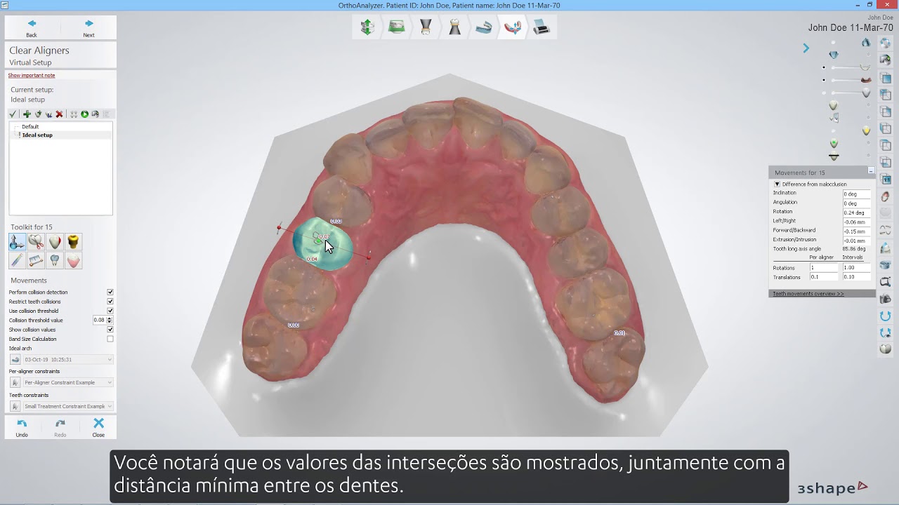 3Shape Clear Aligner Studio - Intersection Visualization and Collision Detection BR PT