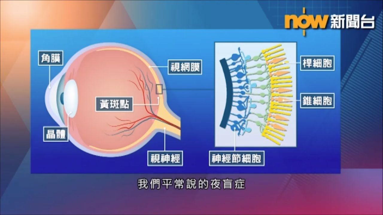中大眼科 x Now 新聞 : 夜盲症都有先天、後天之分？併發症又會點樣危害視力？