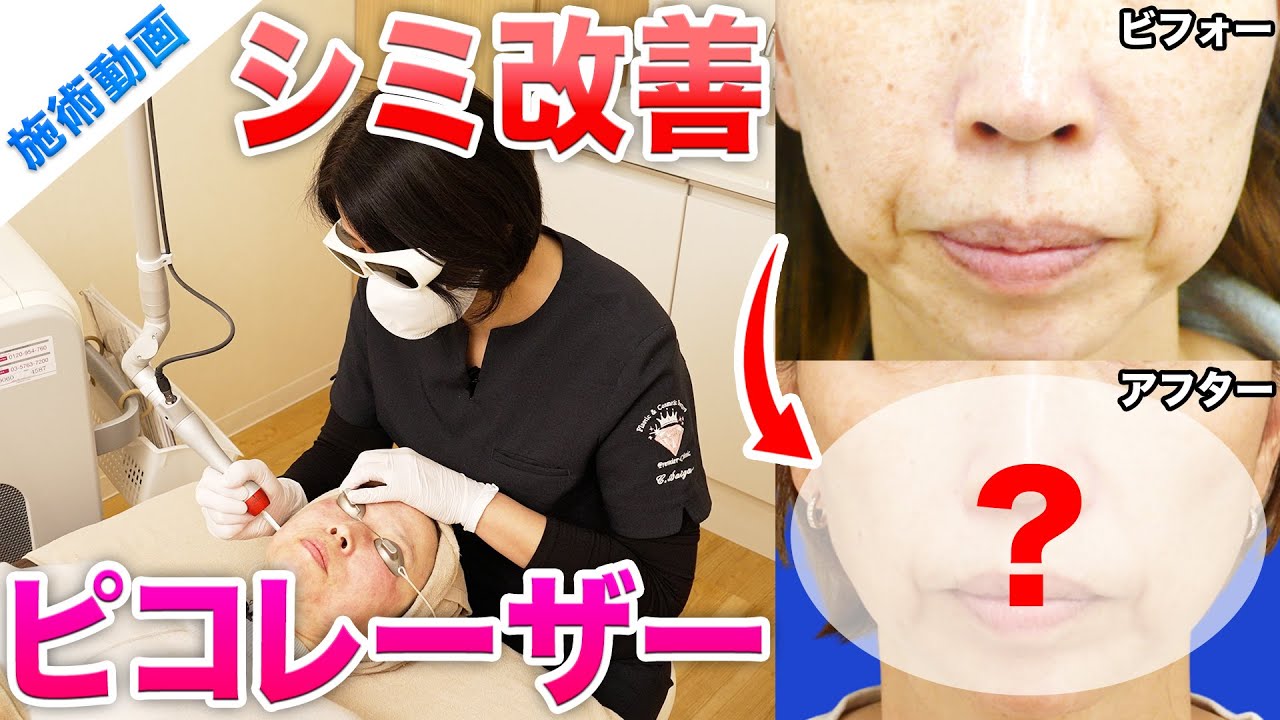 【シミ治療】ピコレーザー施術の様子を大公開！【シミ・くすみ・肝斑】
