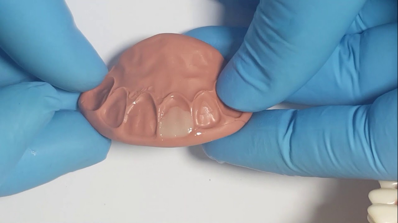 Palatal index (Layering technique )