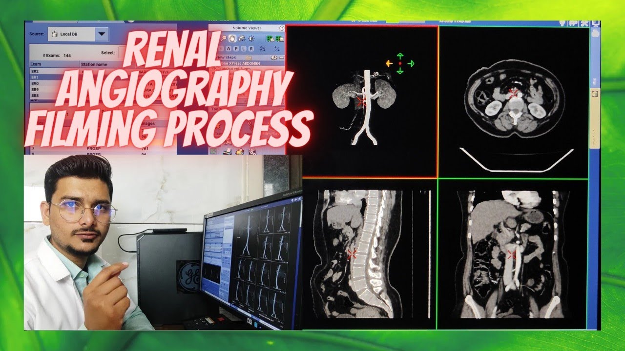 Renal Angiography CT Scan Filming Process & techniques #angiography #radiologytechnologist