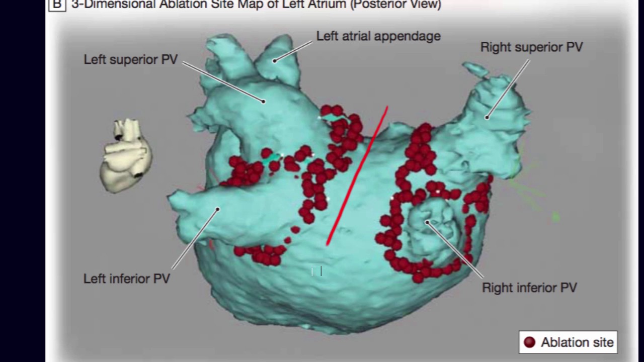 Risks and complications of atrial fibrillation ablation.
