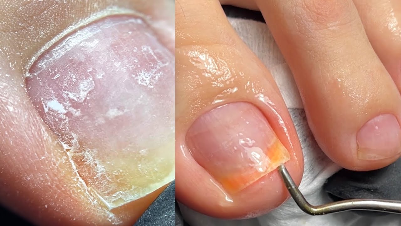 Pedicura 🙁 ¿QUE PASA CON LAS UÑAS?