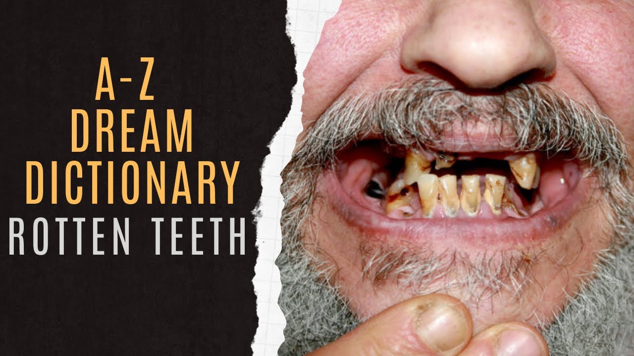 🦷Dreaming Of Rotten Teeth And Its Meaning | Symbolic Meaning Of Rotten Teeth Dream