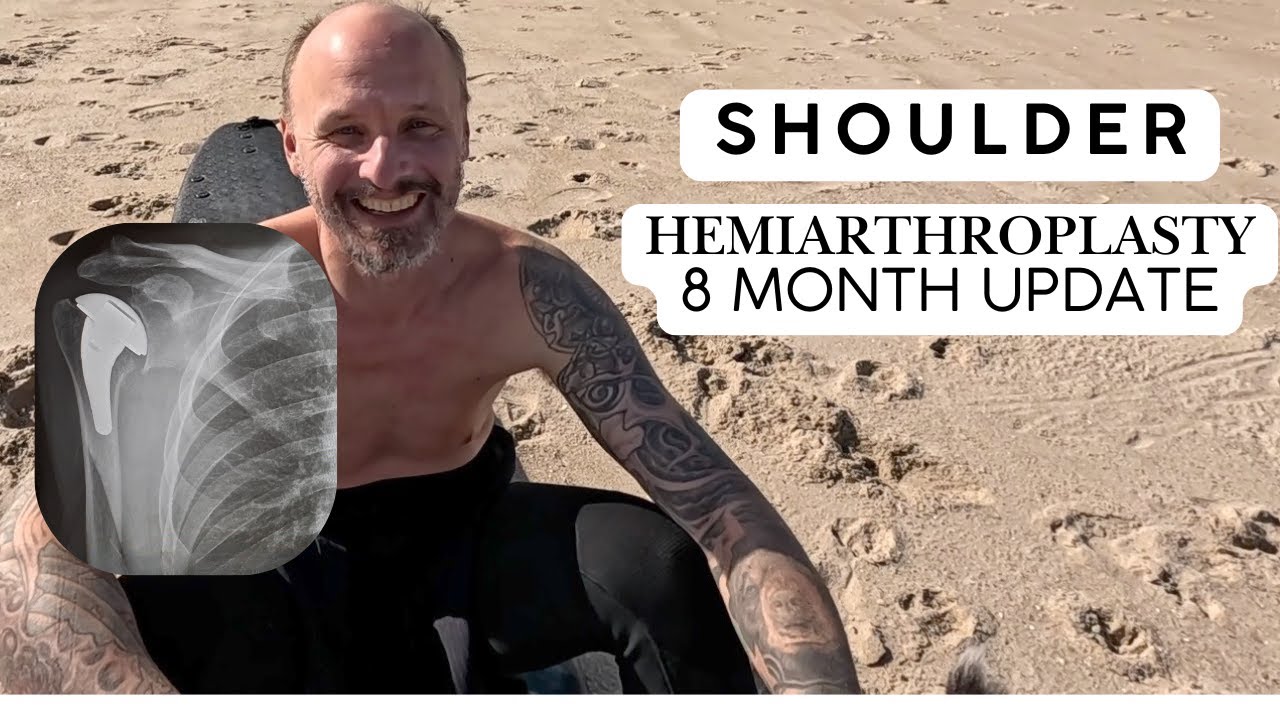 Shoulder Hemiarthroplasty Partial Replacement 8 Month Post Surgery Update + Van Life Beach Day