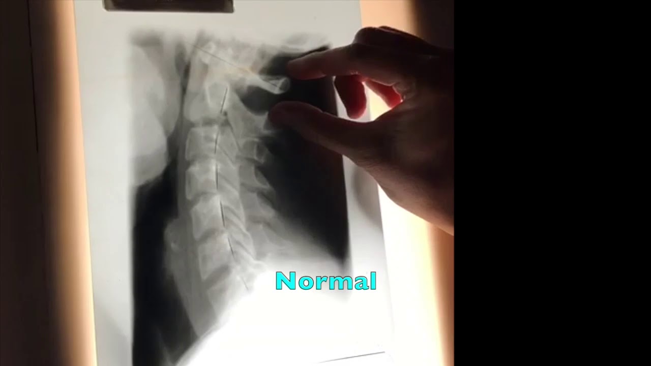 Better Pain Relief with X ray Analysis | Upland Claremont Cucamonga Chiropractor
