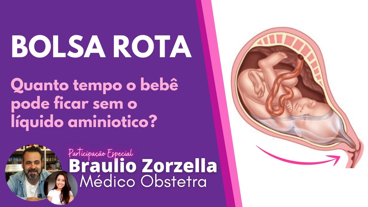 BOLSA ROTA | Quanto tempo o bebê pode ficar na barriga sem líquido?  Braulio Zorzella - Boa Gravidez