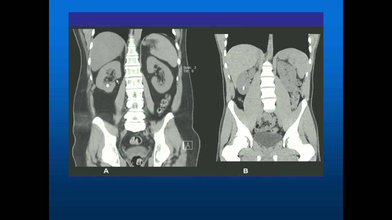 Kidney Stones Alternatives to the ER stones505