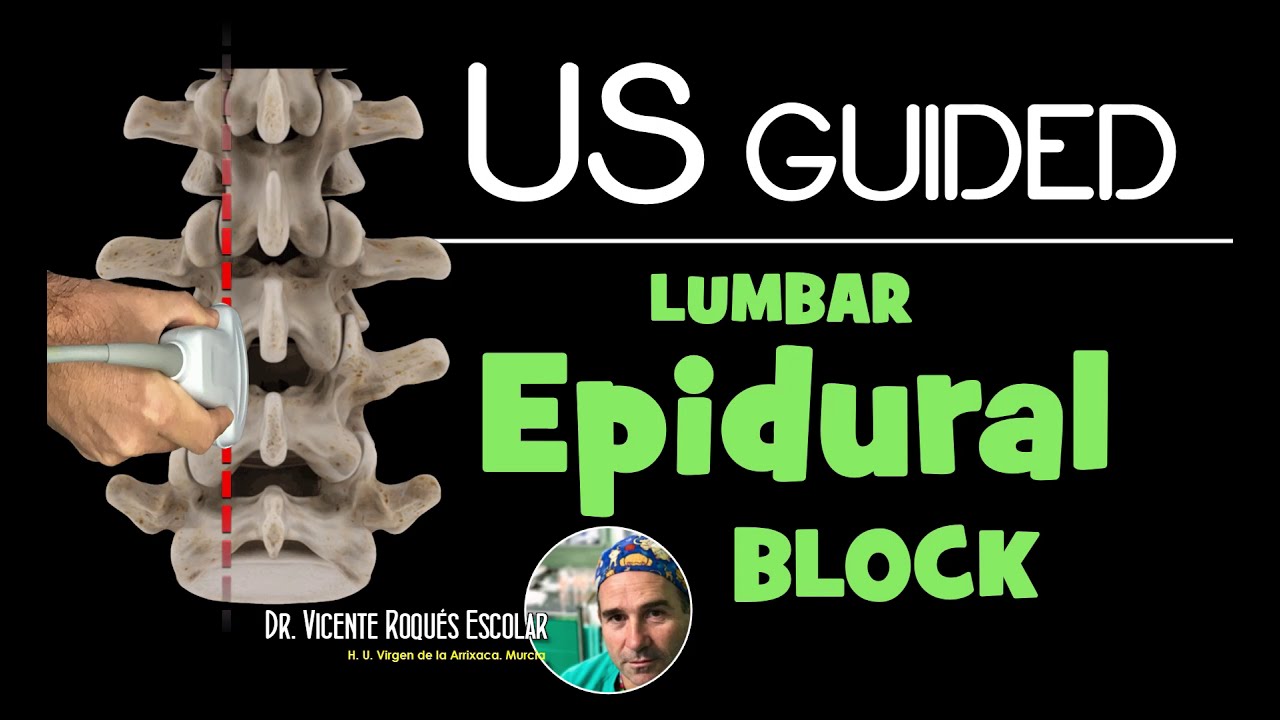 ULTRASOUND GUIDED LUMBAR EPIDURAL INFILTRATION