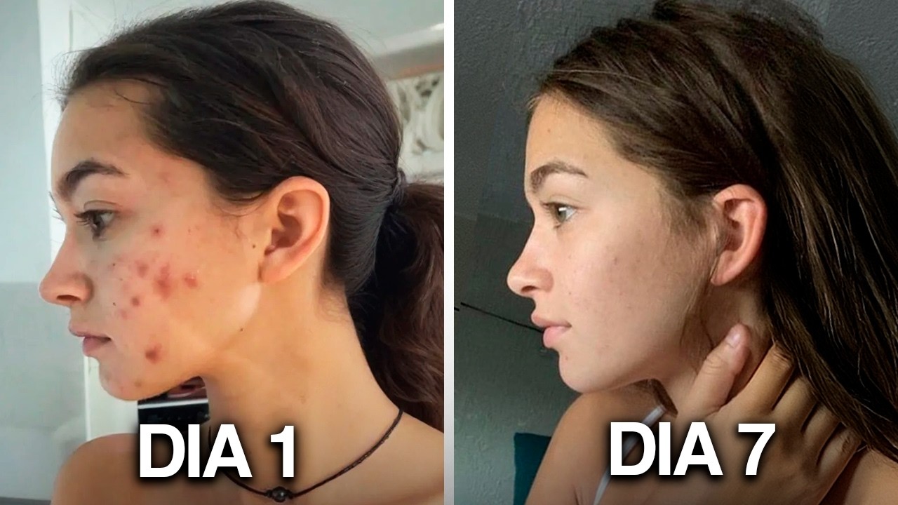 C&oacute;mo pasar de MANCHAS Osuras a una PIEL PERFECTA en 1 semana