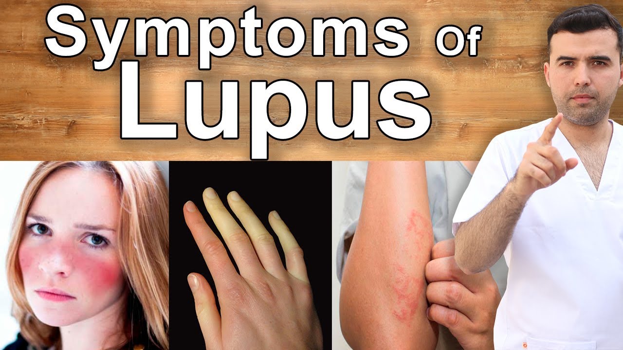 Signs and Symptoms of Lupus – How to Detect Lupus in the Early Stages