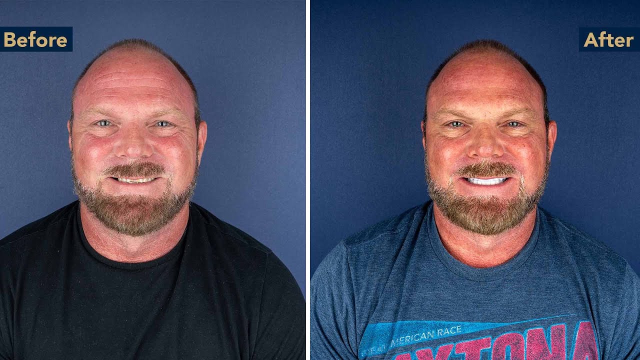 From the USA to Kristal Clinic | Paul’s Emax Transformation