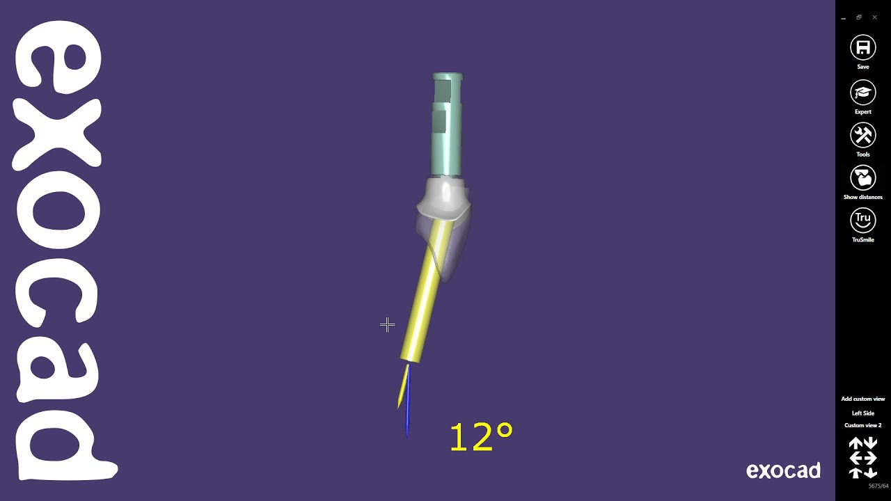 exocad Quick Guide: Angulated Screw Channel