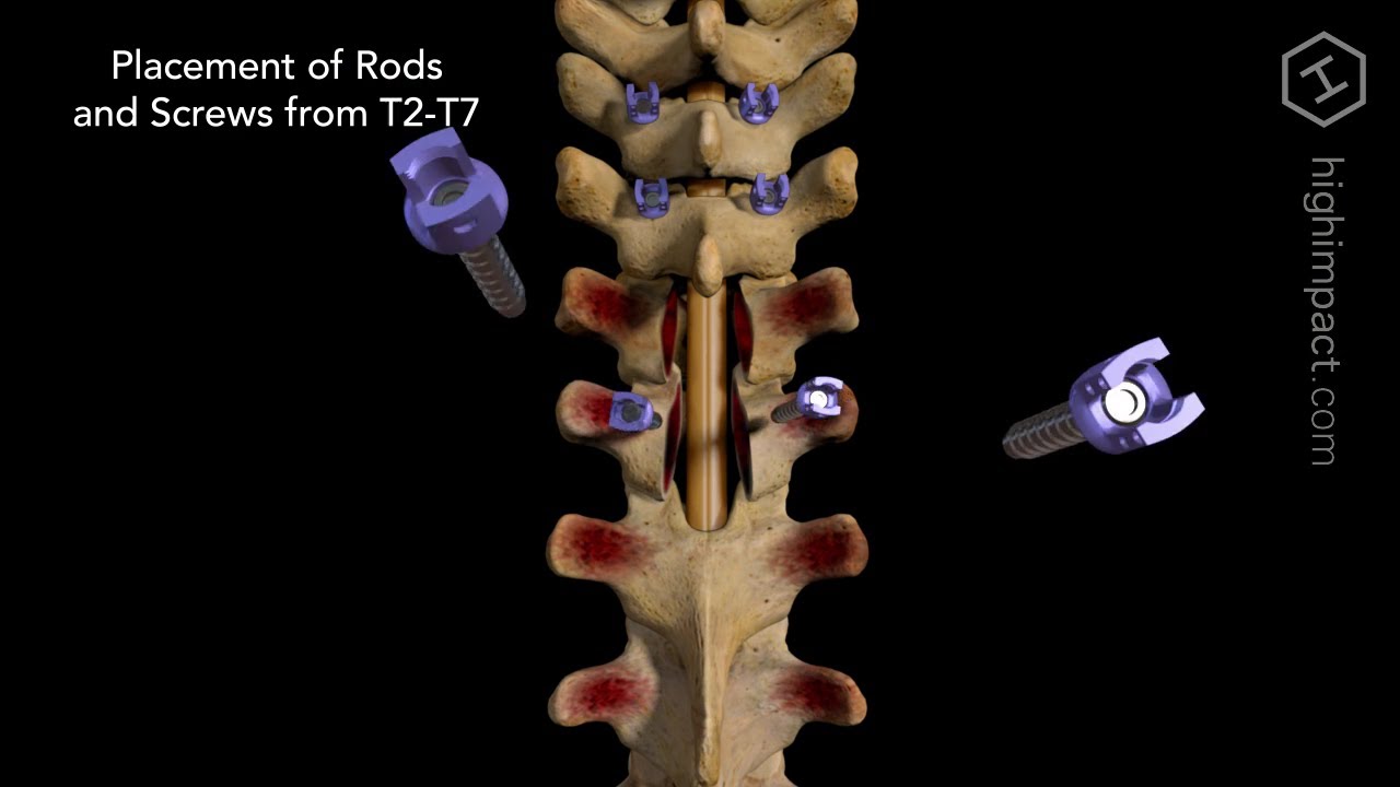 Open Reduction Internal Fixation of T4 with Posterolateral Fusion from T2 to T7