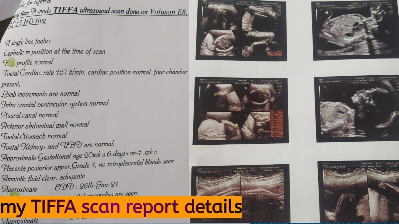 My TIFFA scan report details in telugu || gender reveal || heart rate || baby weight ||