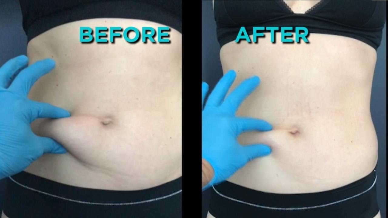 Could This Body Tightening Procedure Replace the Tummy Tuck?